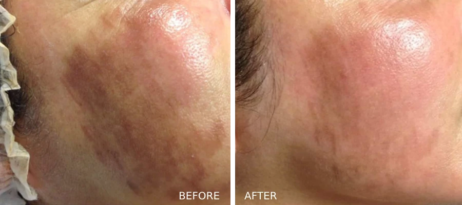 glo2Facial-cheek-before-and-afters-treatment