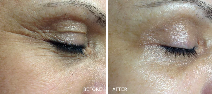 glo2Facial-eyes-before-and-afters-treatment