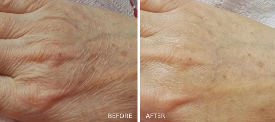 glo2Facial-hands-before-and-afters-treatment