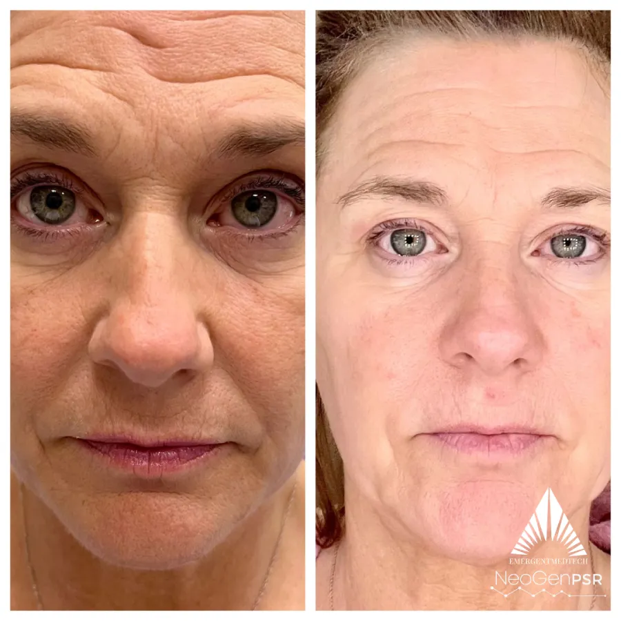 NeoGen before and after photos of a woman's face showing a brighter and clearer skin.