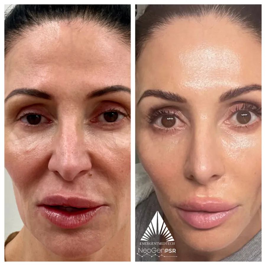 NeoGen before and after photos of a woman's face showing a more brighter, clearer and smoother skin.