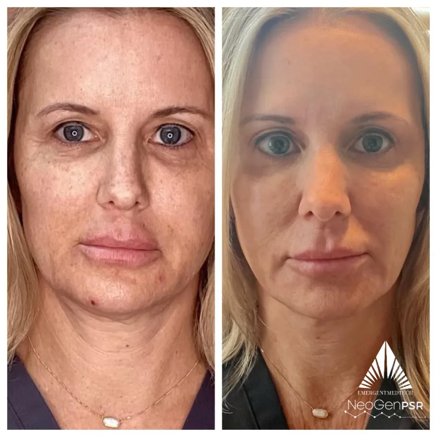 NeoGen before and after photos showing a clearer and brighter skin after treatments.