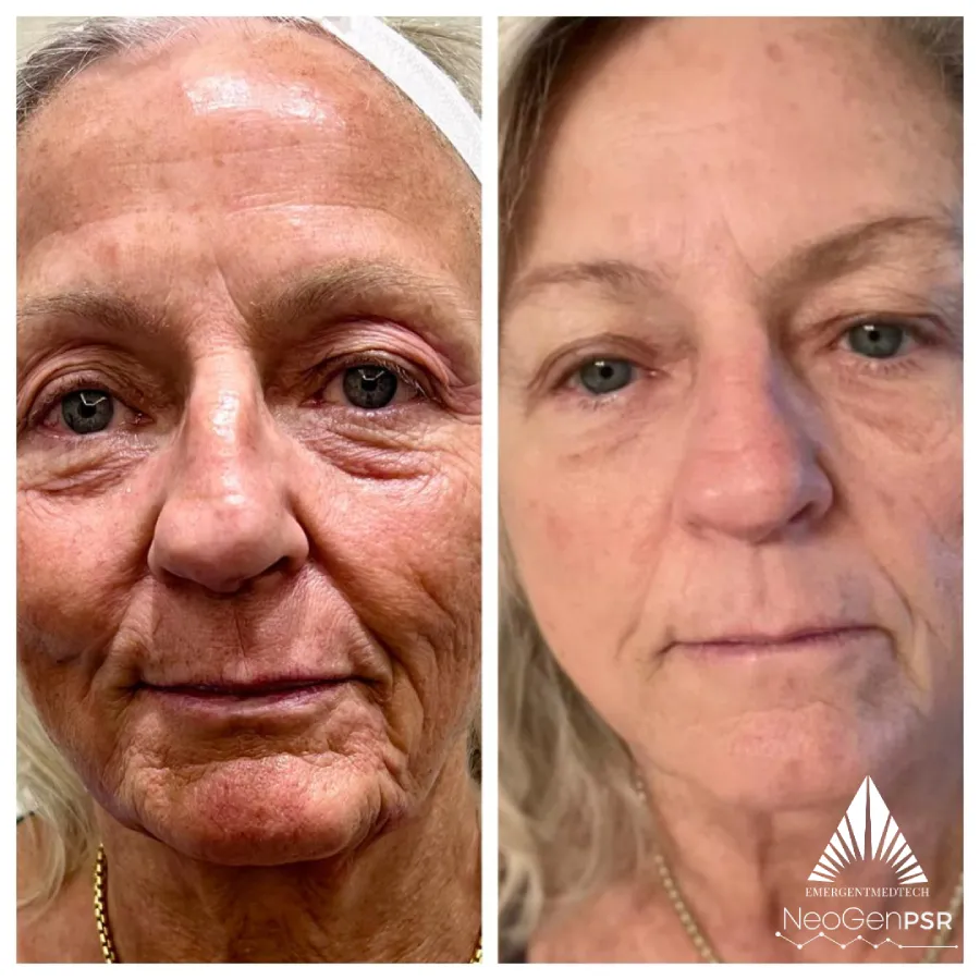 NeoGen before and after photos showing a reduced wrinkles after treatments.