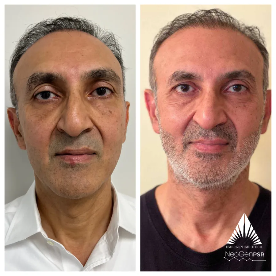 Before and after photos of a man with NeoGen treatments resulting in a more youthful appearance.