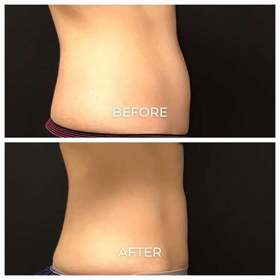 Coolsculpting Elite before and after photos of a woman's abdomen showing results from treatments at Pelle Medical Spa in Manchester, NH.