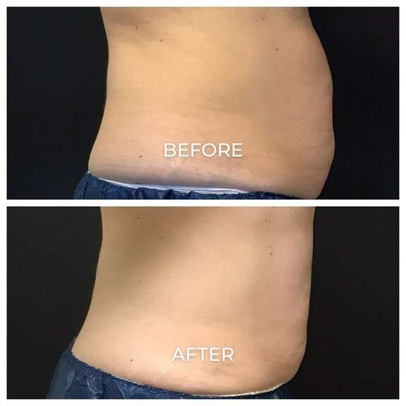 Coolsculpting Elite before and after photos of a woman's abdomen showing results from treatments at Pelle Medical Spa in Manchester, NH.