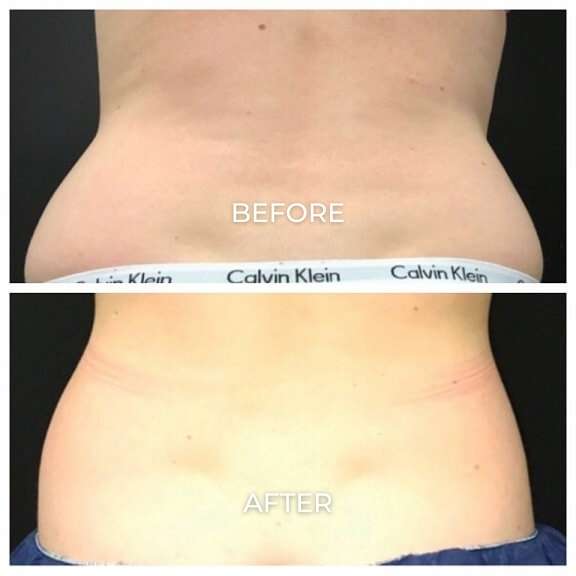 Coolsculpting Elite before and after photos of a woman's back area showing results from treatments at Pelle Medical Spa in Manchester, NH.