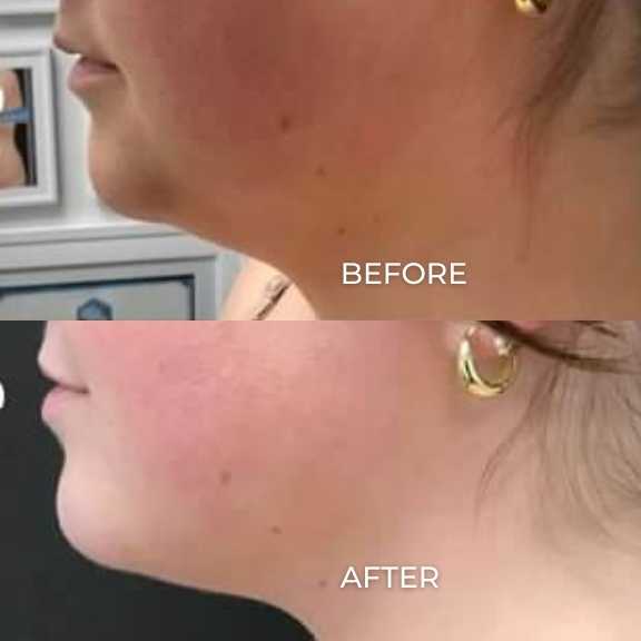 Coolsculpting Elite before and after photos of a woman's chin area showing results from treatments at Pelle Medical Spa in Manchester, NH.