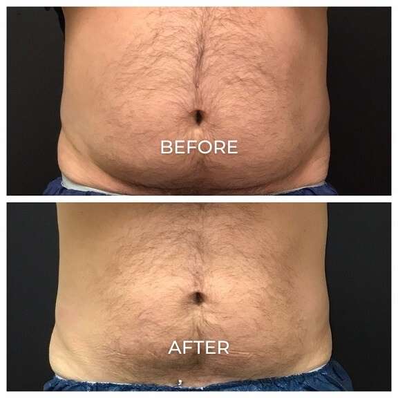 Coolsculpting Elite before and after photos of a man's abdomen showing results from treatments at Pelle Medical Spa in Manchester, NH.