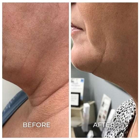Coolsculpting Elite before and after photos of a woman's neck showing results from treatments at Pelle Medical Spa in Manchester, NH.