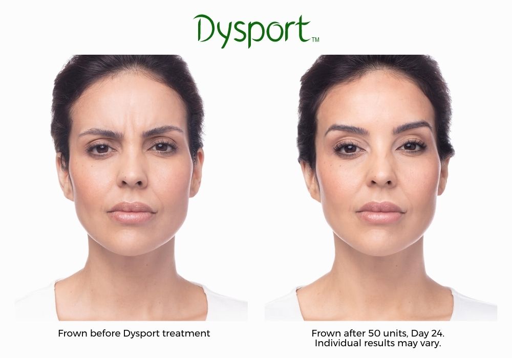Dysport Before and After Image