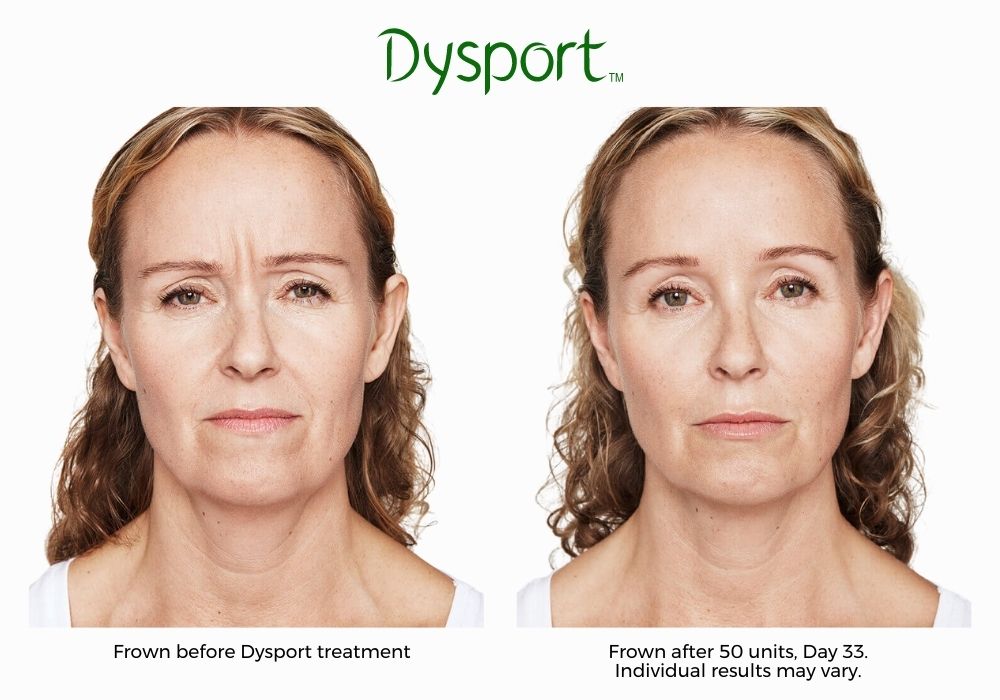Dysport Before and After image