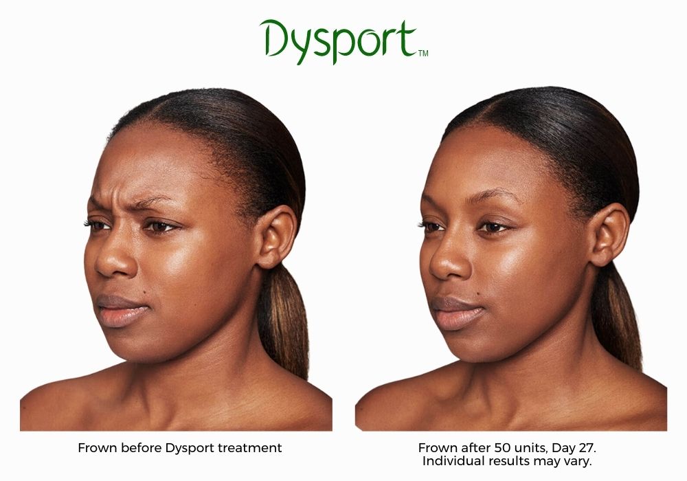 Dysport Before and After image