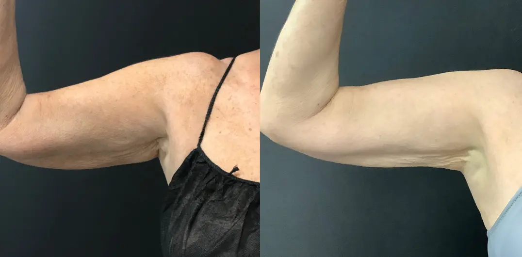 coolsculpting before and after