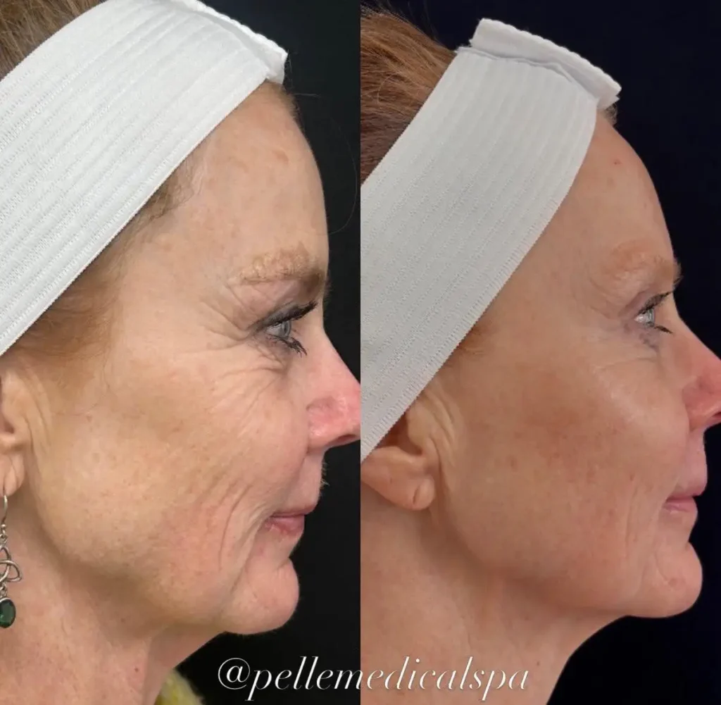 Sculptra in Manchester, NH