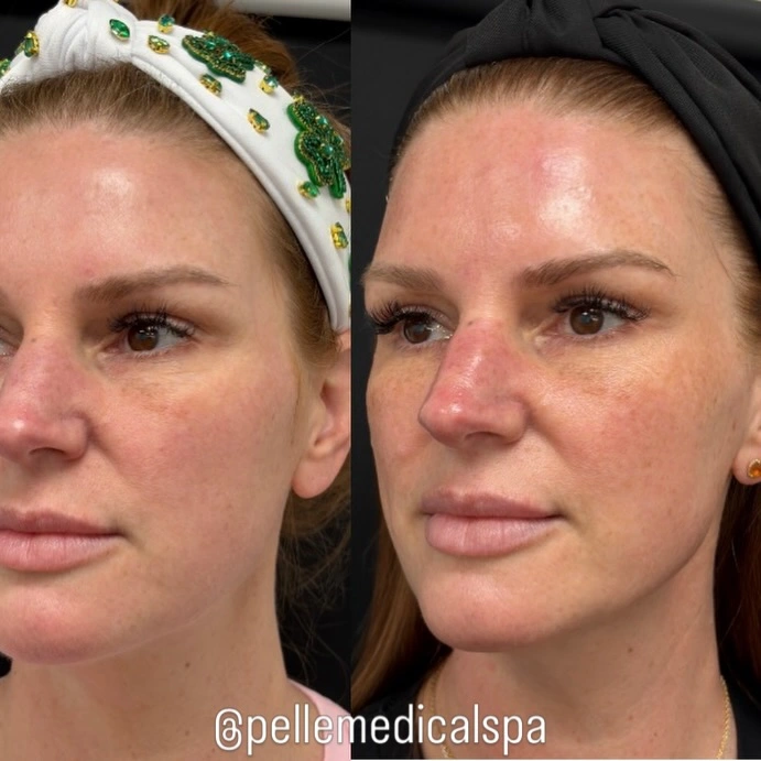 Sculptra before and after Manchester NH